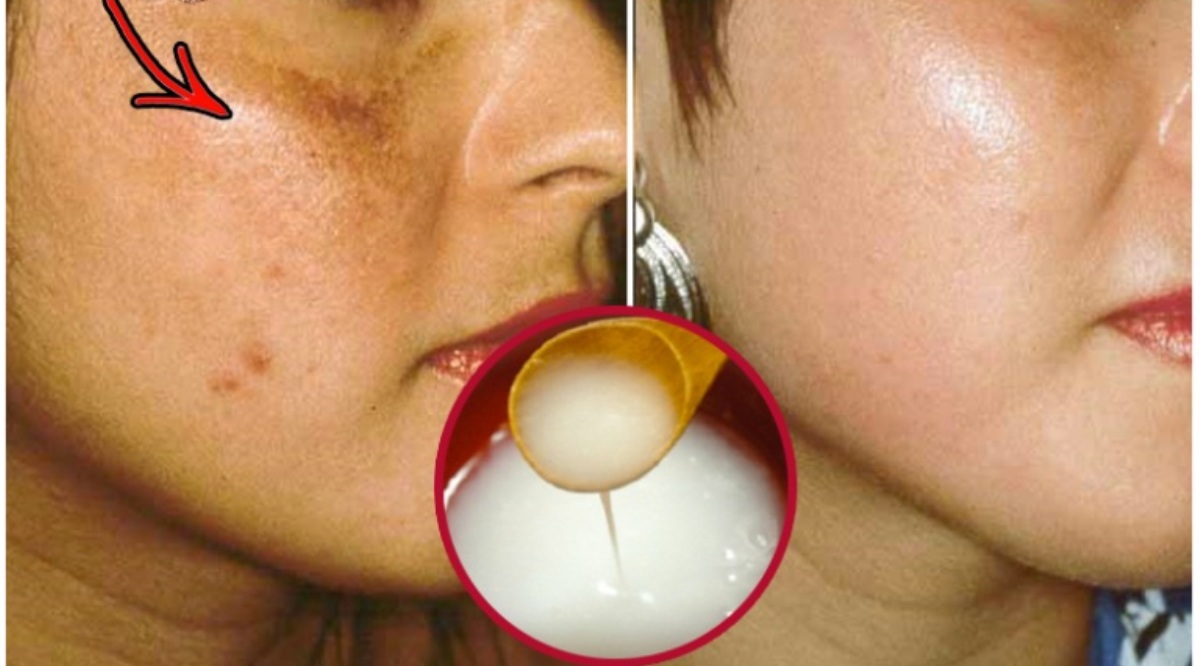 Remove-Brown-Spots-From-Your-Face-Naturally-and-Quickly